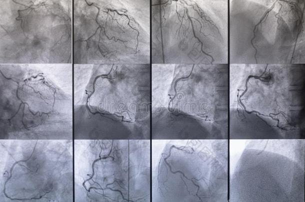 冠的血管、淋巴管造影照片.医学的字母x-射线