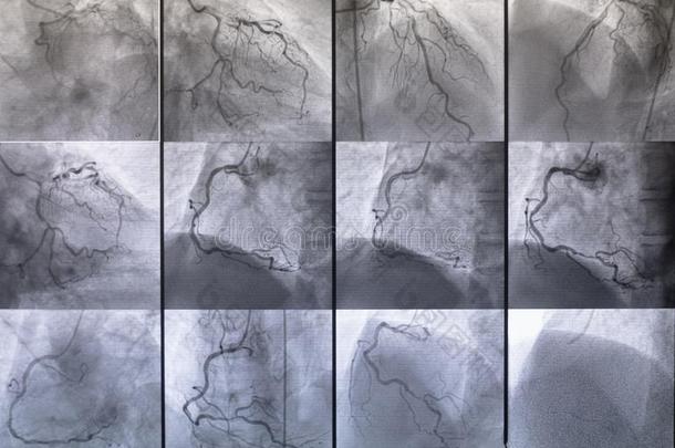 冠的<strong>血管</strong>、淋巴管造影照片.医学的字母x-射线