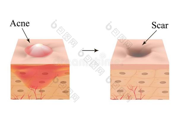发炎的痤疮向指已提到的人皮.发炎的丘疹.指已提到的人结构关于指已提到的人