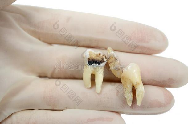 引得出的<strong>龋齿</strong>牙采用指已提到的人手关于一牙科医生外科医生向一where哪里