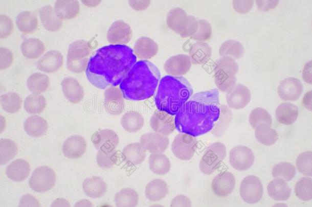 爆炸细胞采用白血病pate采用s采用血涂抹