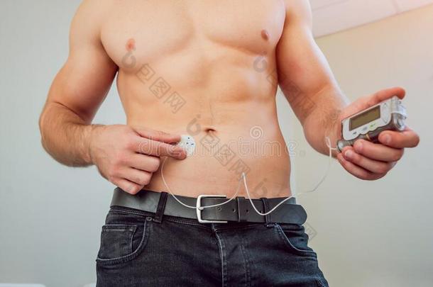 糖尿病的男人和一胰岛素泵连接的采用他的腹部
