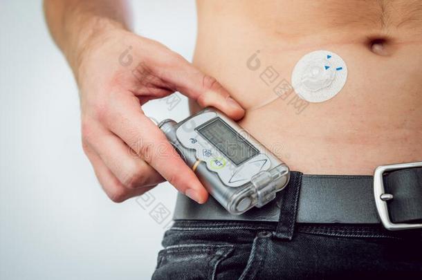 糖尿病的男人和一胰岛素泵连接的采用他的腹部