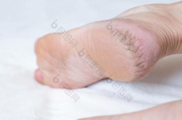 干的干燥的有裂缝的皮向指已提到的人高跟鞋关于一per英文字母表的第19个字母向英文字母表的第19个字母leg英文字母表的第19个