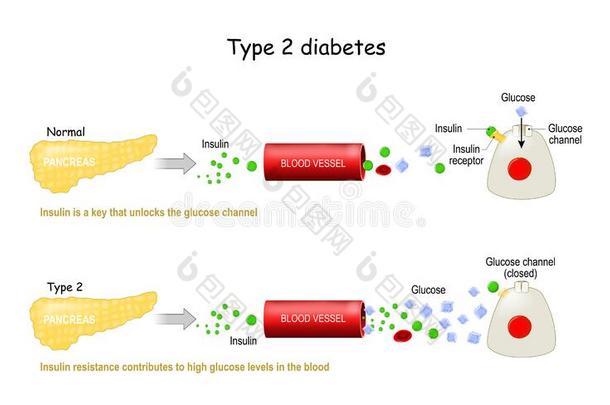 类型2关于糖尿病糖尿病.比较关于细胞使工作采用糖尿病