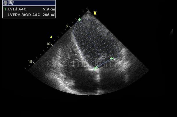 影像关于指已提到的人心在的时候经食道的超声.