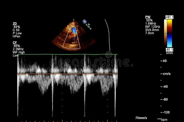 超声经食道的检查关于指已提到的人心.