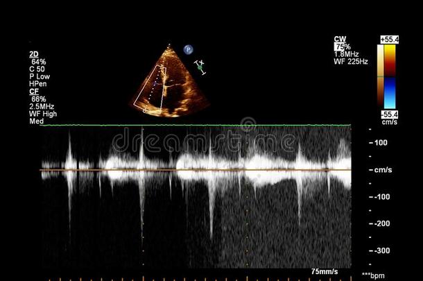 影像关于指已提到的人心在的时候经食道的超声.