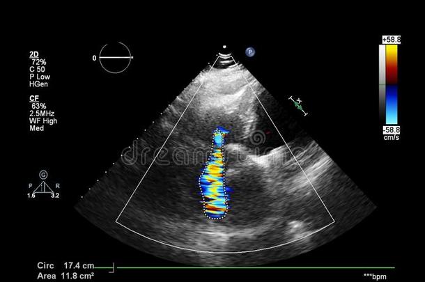 影像关于指已提到的人心在的时候经食道的超声.