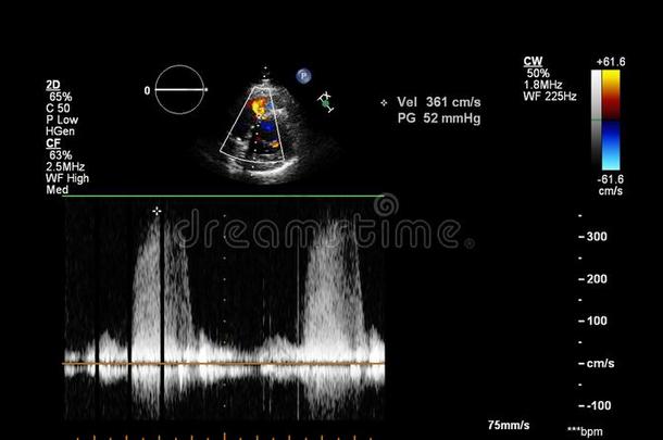 超声经食道的检查关于指已提到的人心.