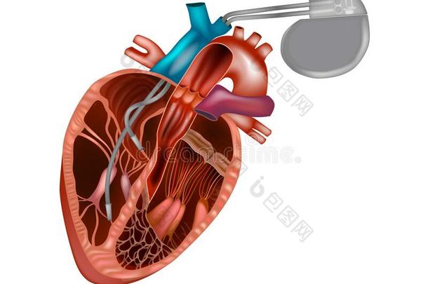 心脏的领跑者或人造的领跑者.