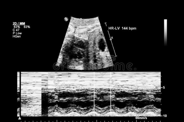 超声检查关于指已提到的人胎儿的心.