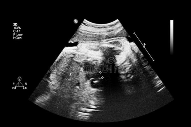 超声检查关于指已提到的人胎儿的心