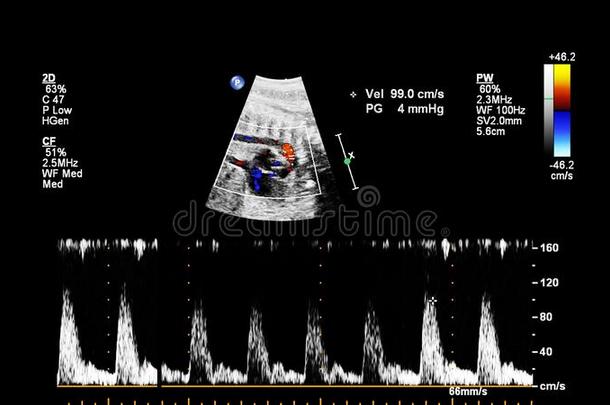 超声检查关于指已提到的人胎儿的心