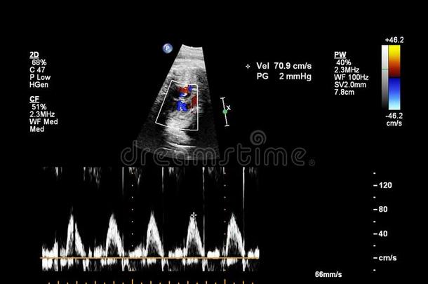 超声<strong>检查</strong>关于指已提到的人<strong>胎儿</strong>的心