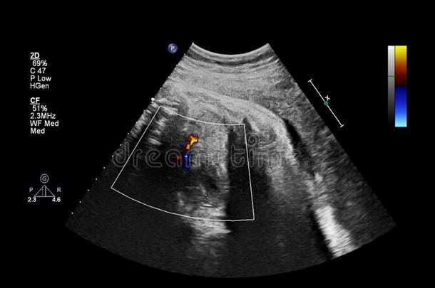 超声检查关于指已提到的人胎儿的心