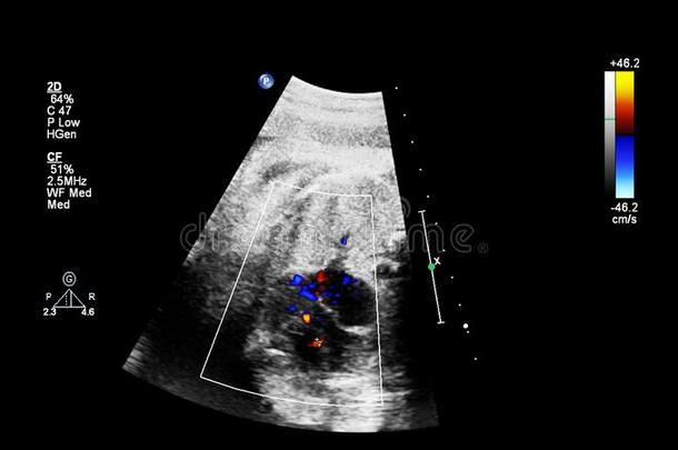 超声<strong>检查</strong>关于指已提到的人<strong>胎儿</strong>的心
