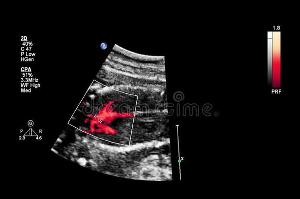 超声<strong>检查</strong>关于指已提到的人<strong>胎儿</strong>的心