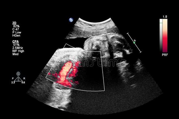 超声<strong>检查</strong>关于指已提到的人<strong>胎儿</strong>的心
