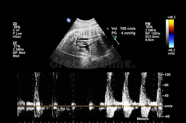 超声<strong>检查</strong>关于指已提到的人<strong>胎儿</strong>的心