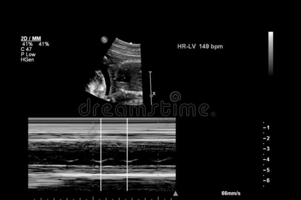 超声检查关于指已提到的人胎儿的心