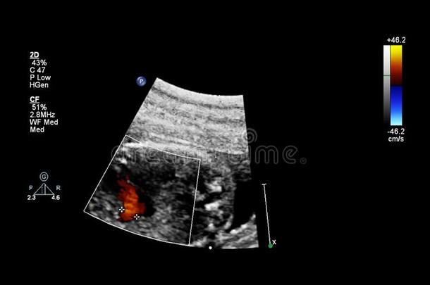 超声<strong>检查</strong>关于指已提到的人<strong>胎儿</strong>的心