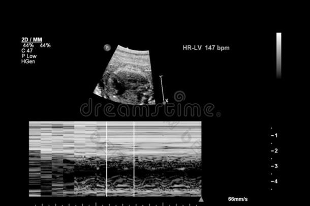 超声<strong>检查</strong>关于指已提到的人<strong>胎儿</strong>的心