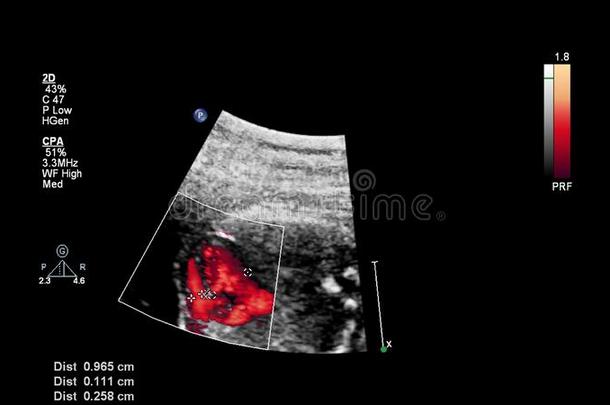 超声检查关于指已提到的人胎儿的心