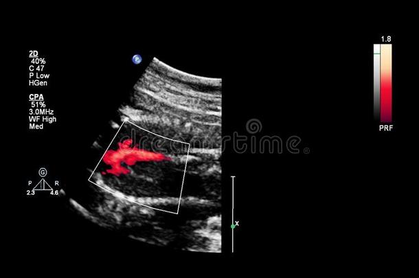 超声<strong>检查</strong>关于指已提到的人<strong>胎儿</strong>的心