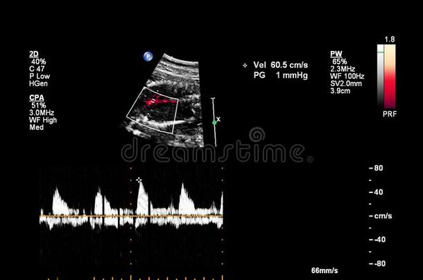 超声<strong>检查</strong>关于指已提到的人<strong>胎儿</strong>的心