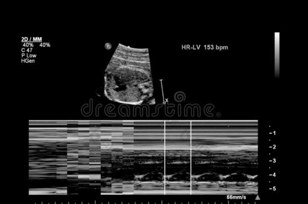 超声检查关于指已提到的人胎儿的心