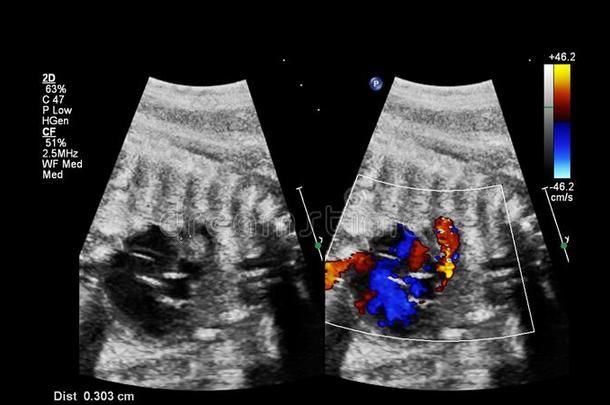 超声检查关于指已提到的人胎儿的心