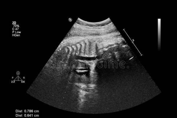 超声<strong>检查</strong>关于指已提到的人<strong>胎儿</strong>的心