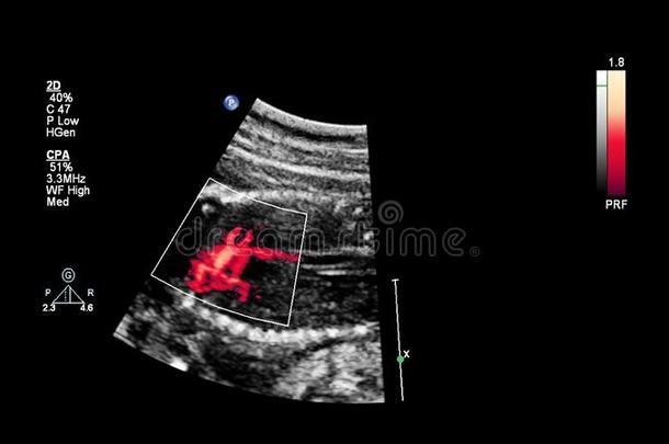 超声检查关于指已提到的人胎儿的心
