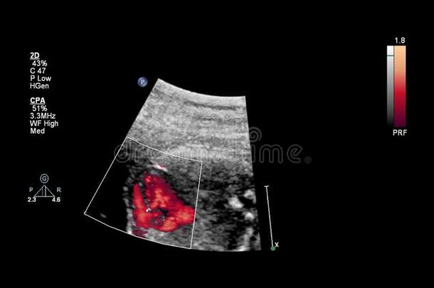 超声<strong>检查</strong>关于指已提到的人<strong>胎儿</strong>的心