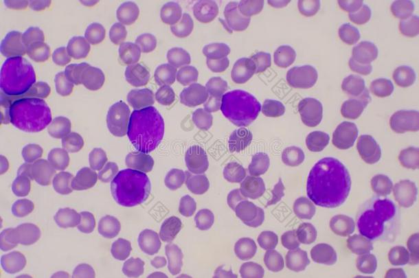 不成熟的白色的血细胞采用血涂抹