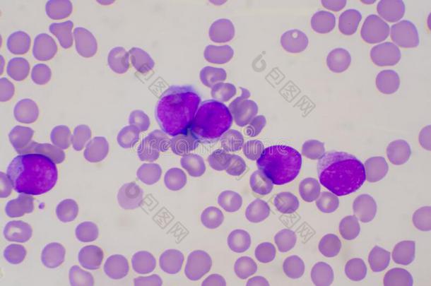 不成熟的白色的血细胞采用血涂抹