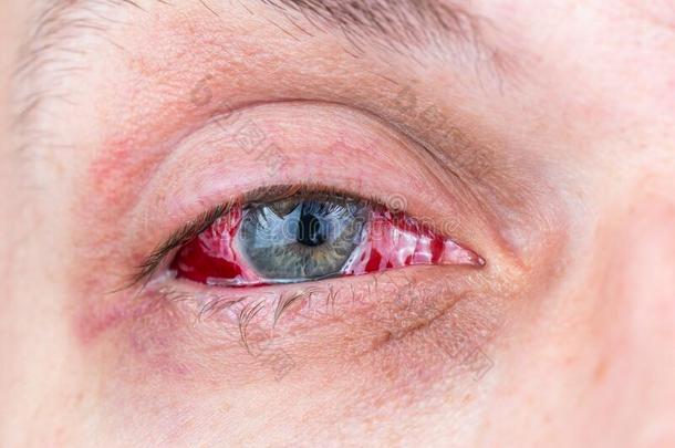 手术后的重的发炎的眼睛关-在上面射手和精心选择的FaroeIslands法罗群岛