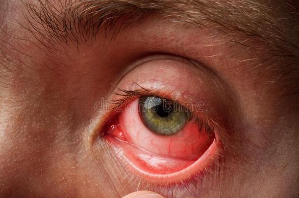 结膜炎,结膜的炎症,红色的眼睛,传染一