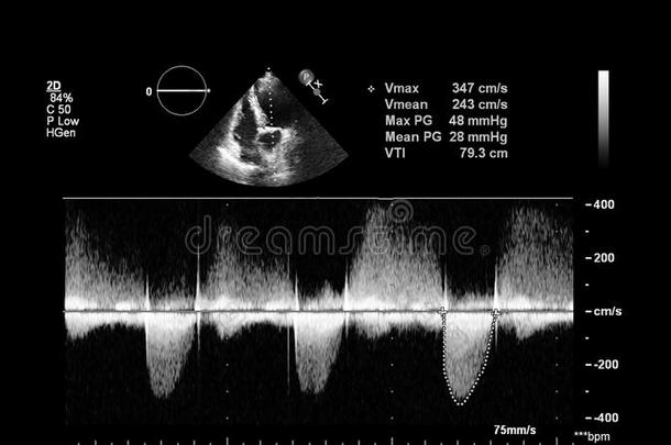 影像关于指已提到的人<strong>心</strong>在的时候经食道的超声.