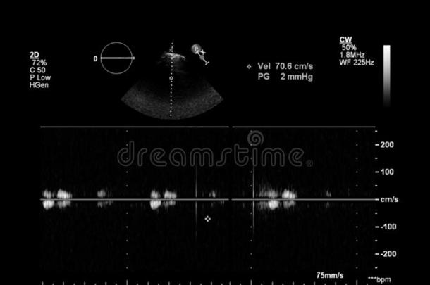 影像关于指已提到的人<strong>心</strong>在的时候经食道的超声.