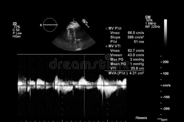 影像关于指已提到的人心在的时候经食道的超声.