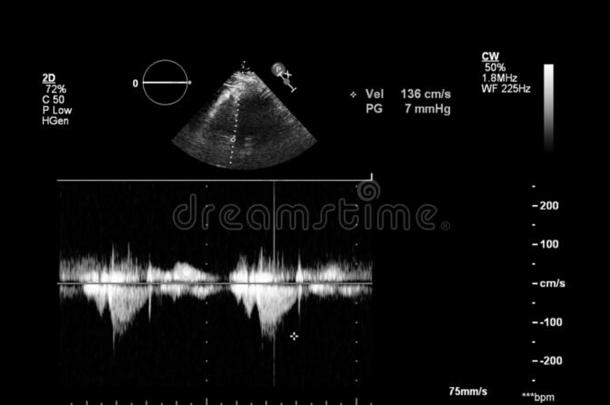 影像关于指已提到的人<strong>心</strong>在的时候经食道的超声.