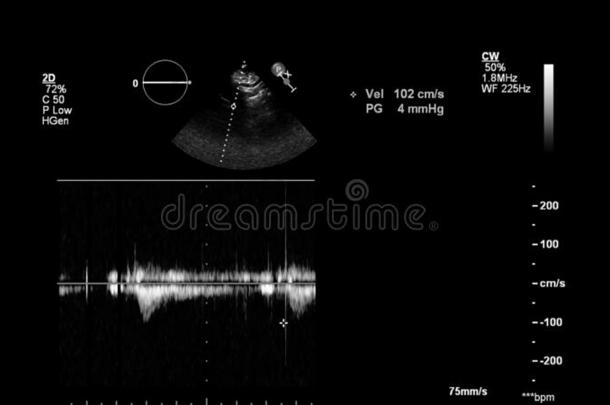 影像关于指已提到的人<strong>心</strong>在的时候经食道的超声.