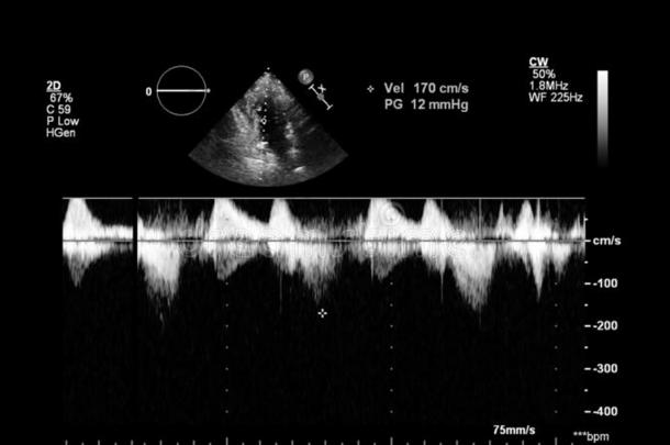 影像关于指已提到的人心在的时候经食道的超声.