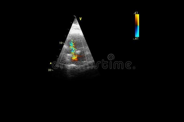 影像关于指已提到的人心在的时候经食道的超声.