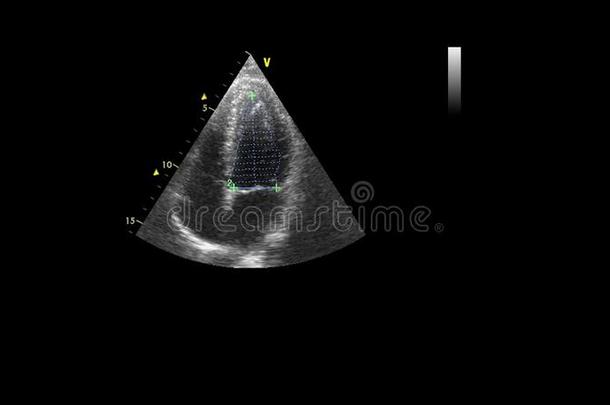 影像关于指已提到的人心在的时候经食道的超声.
