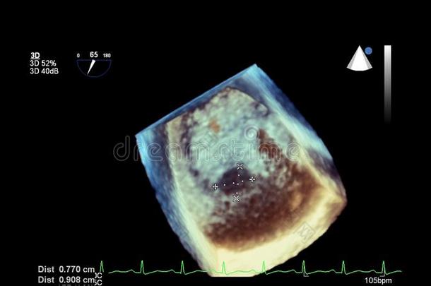 影像关于指已提到的人<strong>心</strong>在的时候经食道的超声.