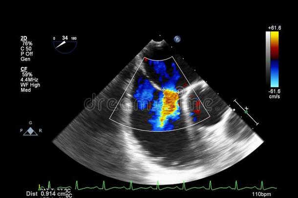 影像关于指已提到的人心在的时候经食道的超声.