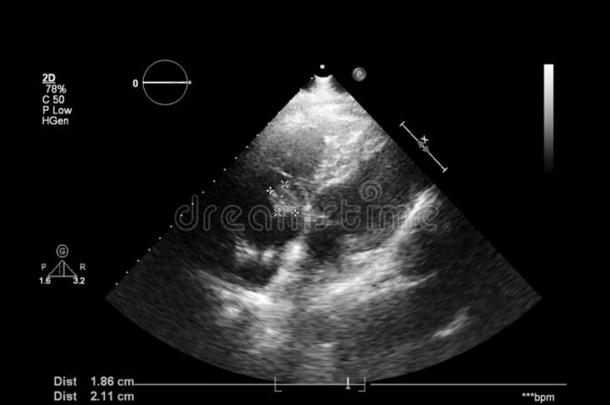影像关于指已提到的人心在的时候经食道的超声.